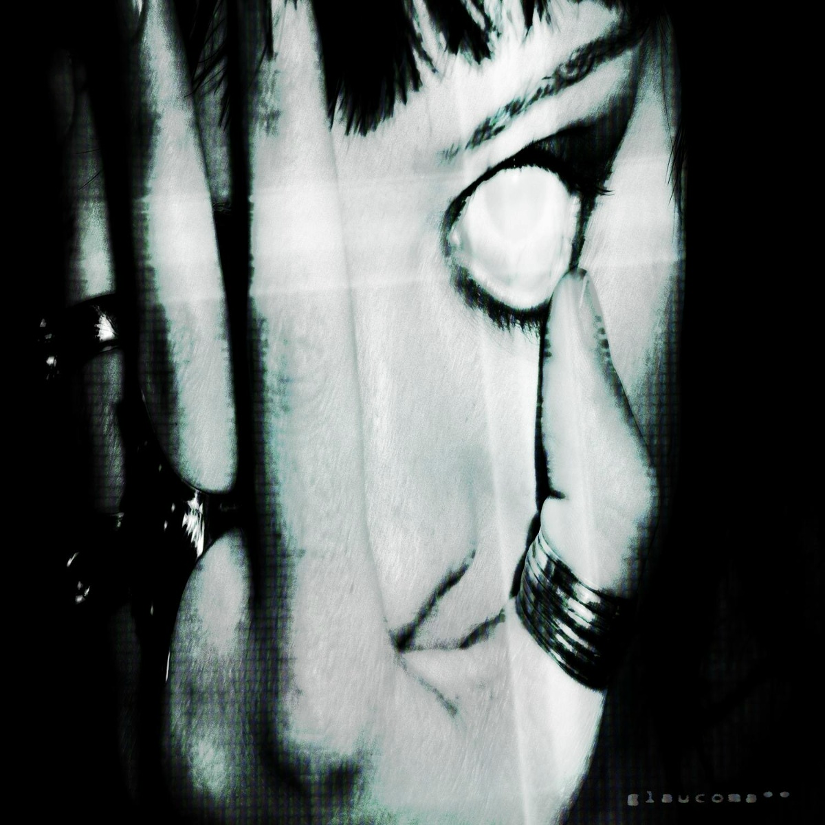glaucoma__ - campbullet